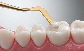 Dolgu Tedavisi Görsel 2