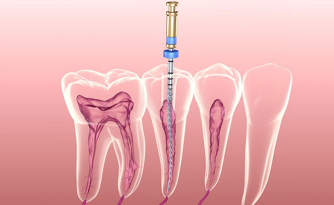 Endodonti Görsel 2